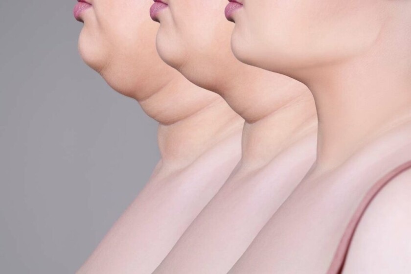 Double Chin Removal Cost