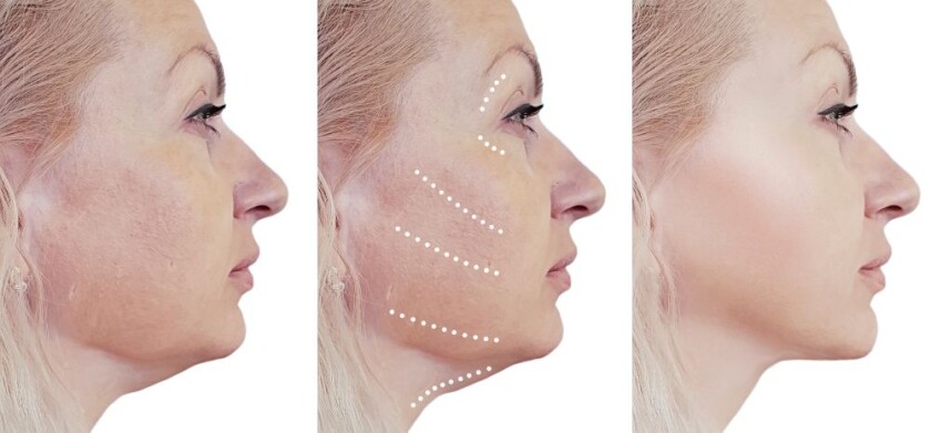 non-surgical facelifts