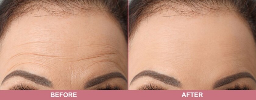 treatment for forehead wrinkles