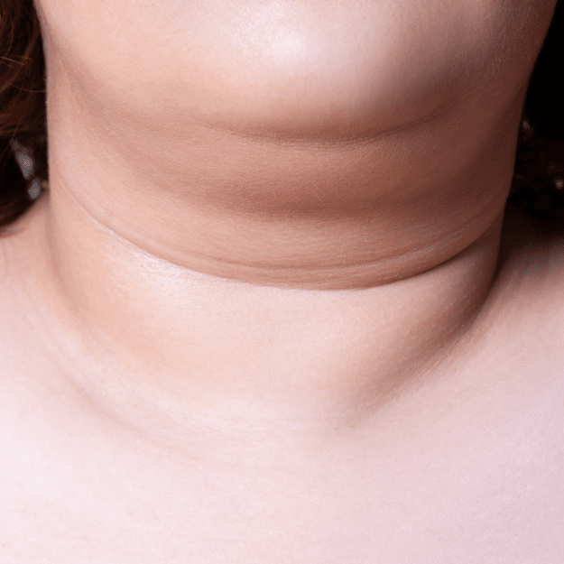 Treatments to getting rid of double chin