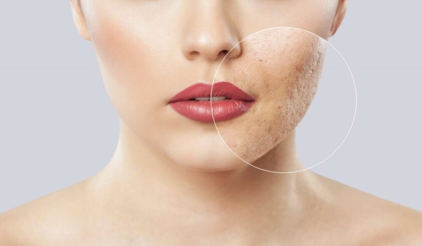How can I fight acne scars