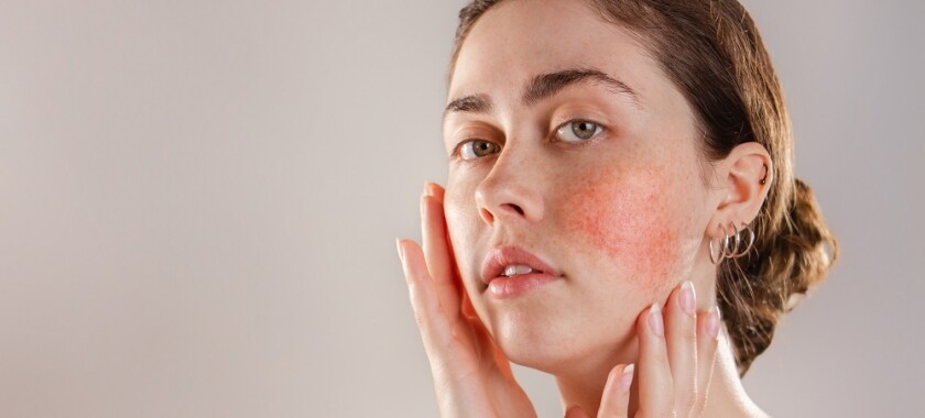 Top Causes and Treatments for Rosacea