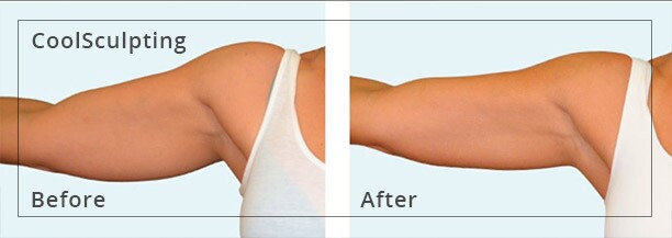 CoolSculpting Toronto